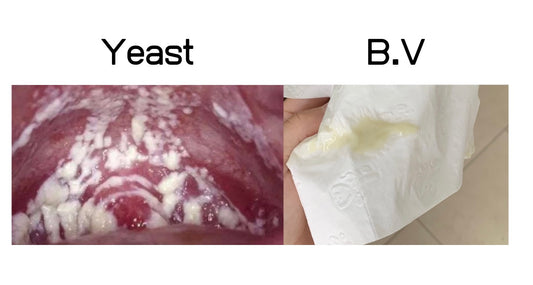 Yeast Infections & Bacterial Vaginosis